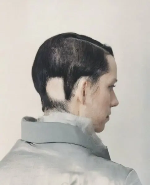 Alopecia Areata: a historical perspective on the role of infectious agents