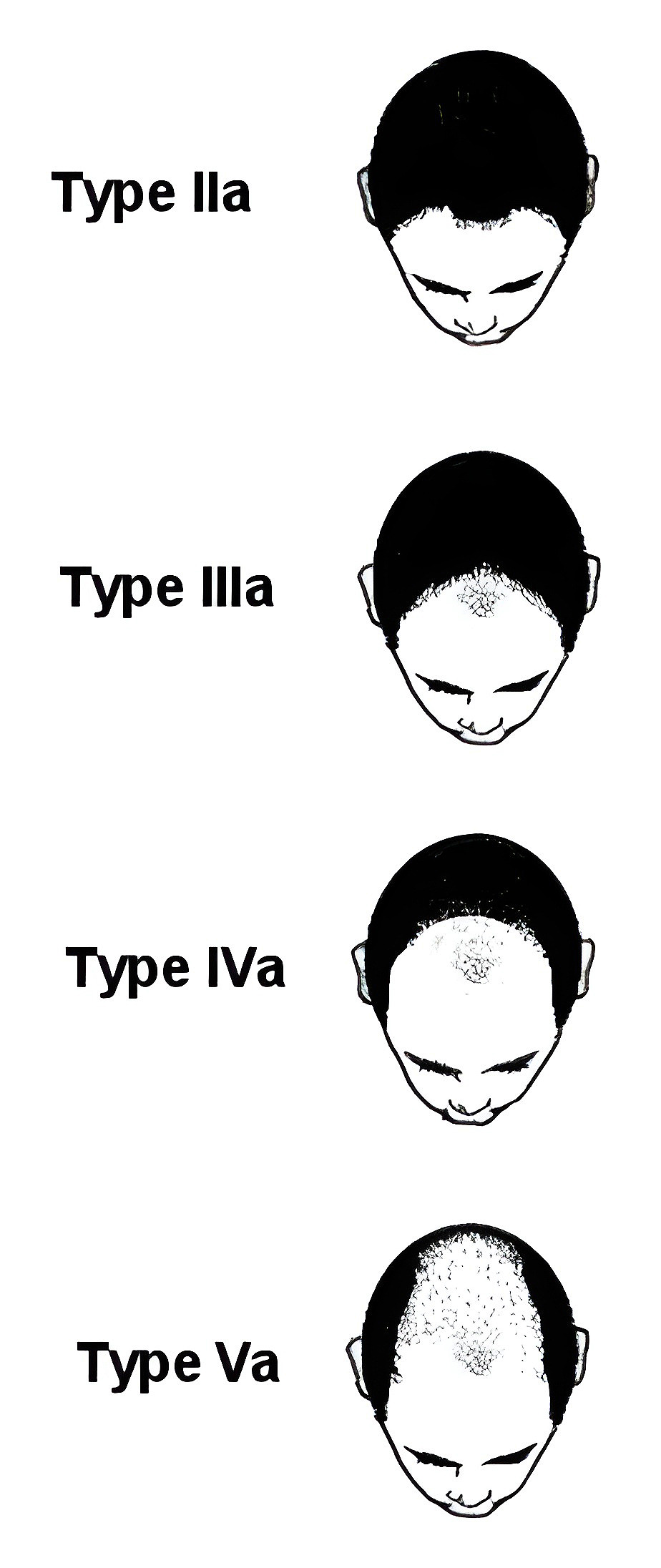 The Norwood Male Pattern Hair Loss Classification System