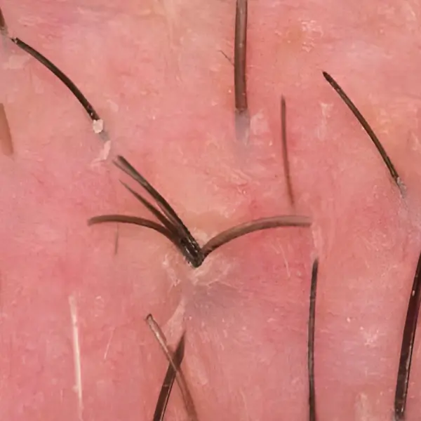 Pili Multigemini: Multiple Hairs Growing from a Single Hair Canal