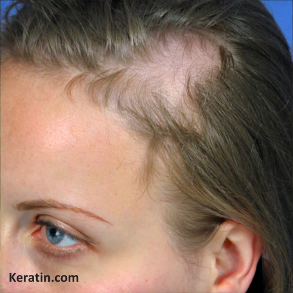 Triangular Alopecia: An Overview